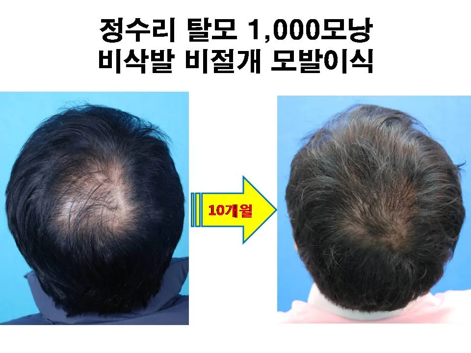 정수리가 아픈 이유와 완화하는 방법_4