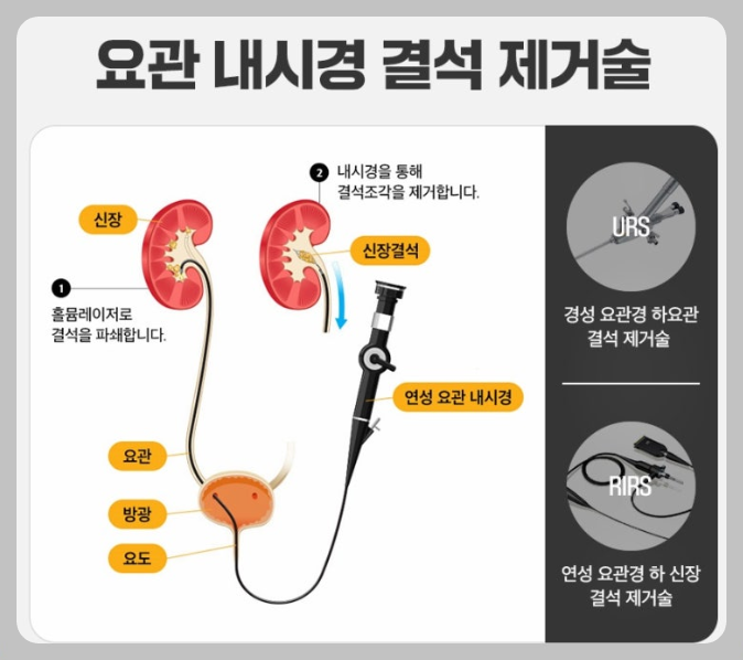결석제거술