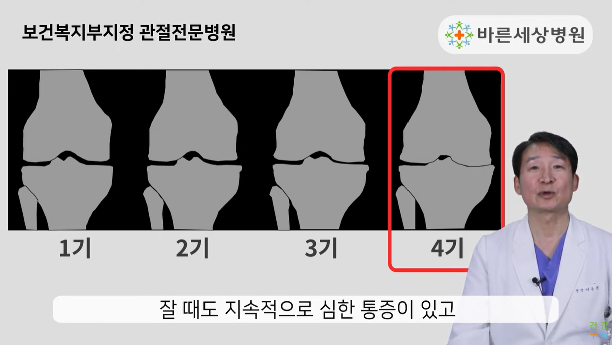 인공 관절염 4기
