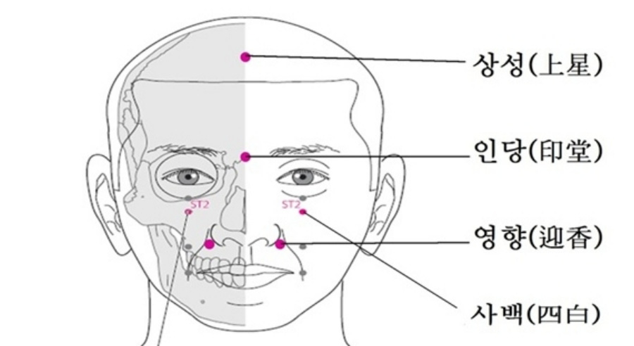 인체의 365혈 중에서 얼굴에 위치를 하고 있는 상성, 인당, 영향, 사백혈의 위치를 표시를 한 이미지 사진