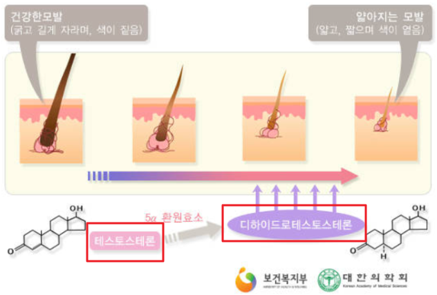 탈모의 원인
남성 호르몬인 테스토스테론이 DHT호르몬으로 변형되어 원인이 된다.