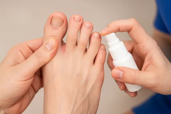 가족 간 무좀 전염 막는 방법