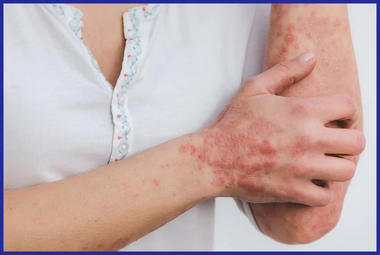 피부 염증 종류별 증상과 치료법 총정리! 제대로 알고 관리하세요