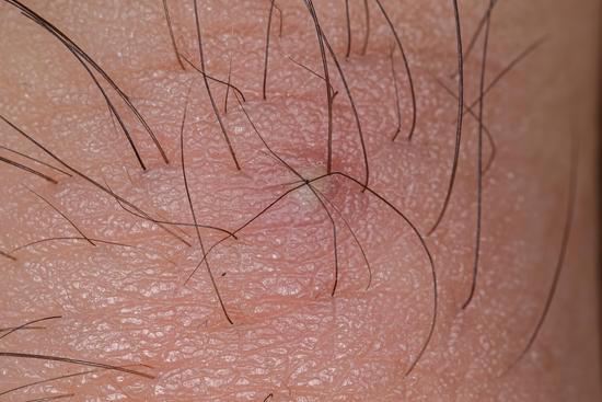 인그로운 헤어 (Ingrown Hair) ❘ 내성모 원인과 치료, 예방법