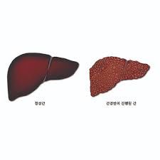 간수치가 올라가는 이유