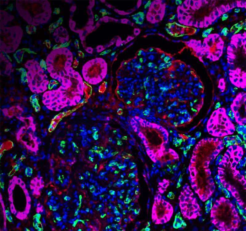 이종장기 유전자변형 돼지 신장 이식