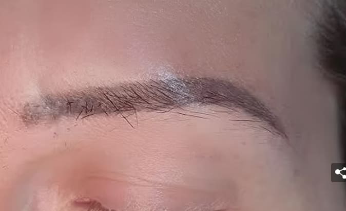 자신의 머리 털로 눈썹 이식한 10대...어머! 숯덩이네! VIDEO:Cotswolds woman undergoes eyebrow transplant using hairs from head