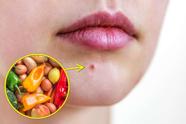 야채 섭취 부족 증상, 뾰루지 원인 여드름 유발, 채소 섭취 부족 증상, 팁줌