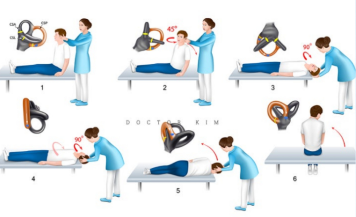 이석증치료-애플리-수기법
