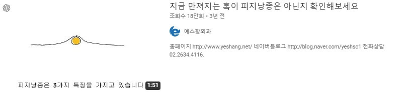 지금 만져지는 혹, 피지낭종인지 확인하세요