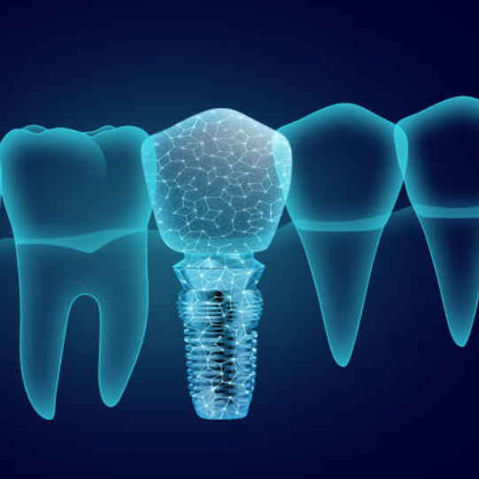 임플란트 가격 및 장단점 비교