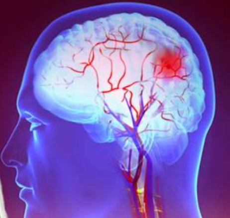 뇌동맥류가 터지면 어떤 결과가 발생할까?