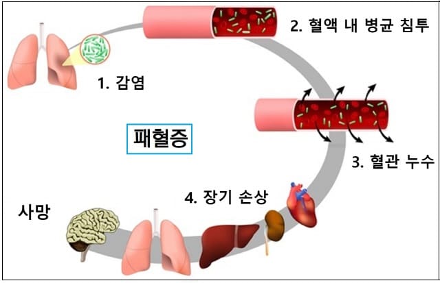 감기인 줄 알고 방치했다가 사망하는 '패혈증(Sepsis)' 