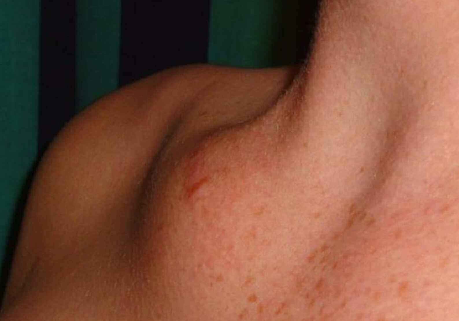 쇄골 멍울 원인