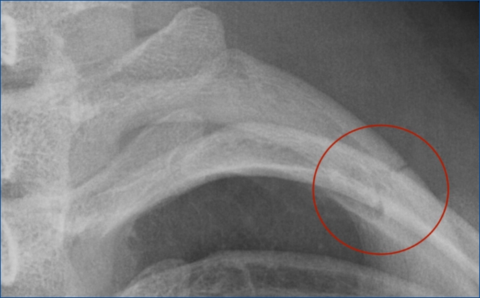 갈비뼈 피로골절