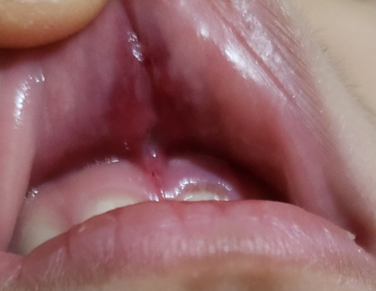 아이 입술찢어짐 입술순소대 찢어졌을때