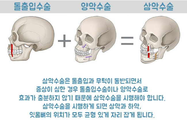 삼악수술의 필요성