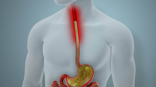 역류성 식도염 증상 체크리스트와 생활 관리법
