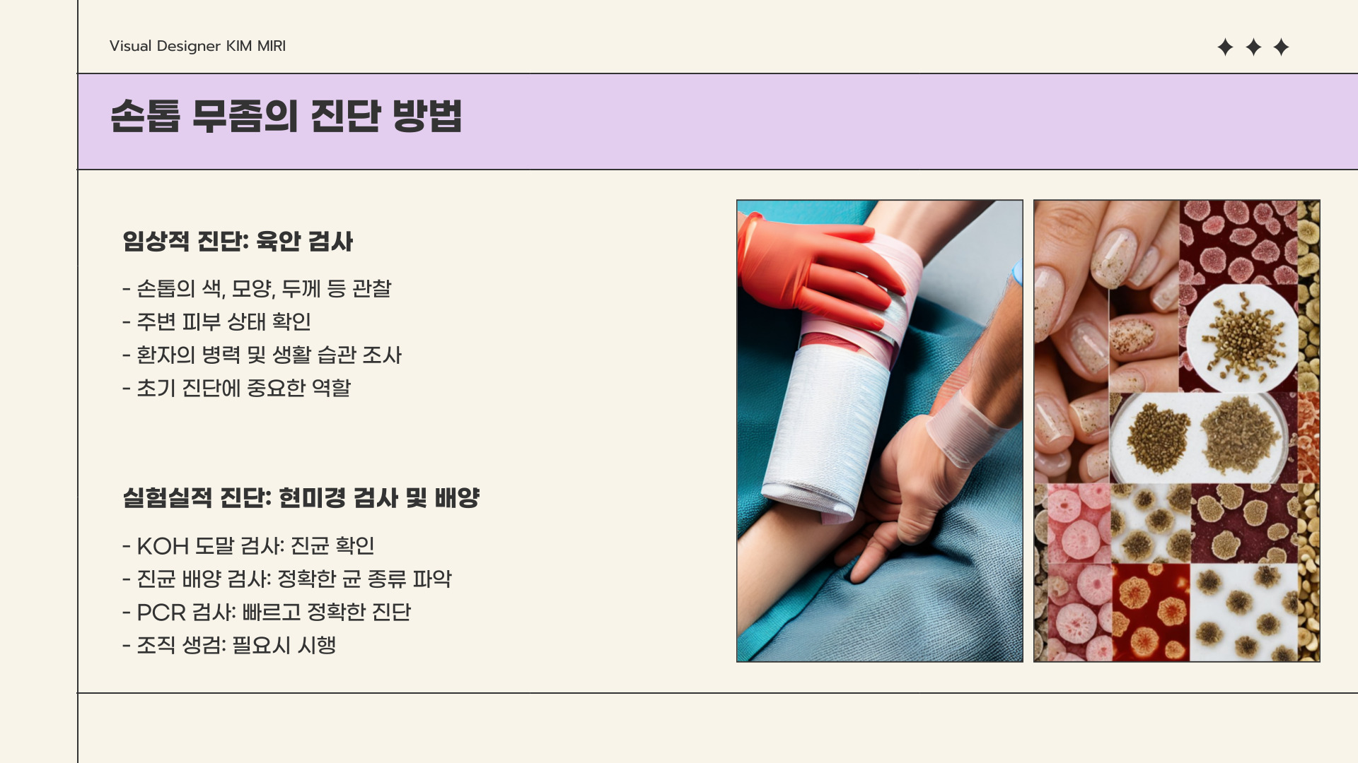 손톱 무좀