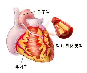 협심증 전조증상