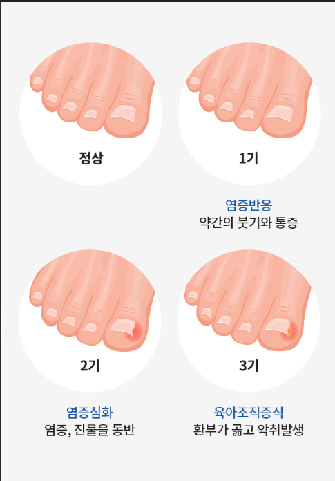 내성발톱 증상, 원인, 치료법 및 예방 방법: 통증 없이 관리하는 법