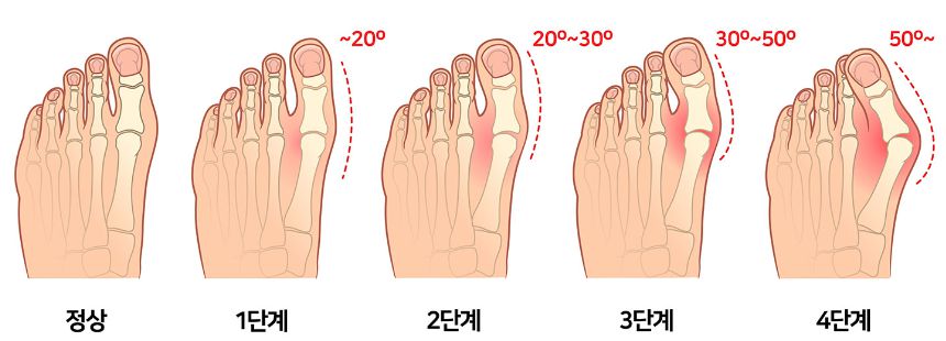 무지외반증증상단계