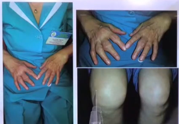 진행된 류마티스 관절염 손가락 무릎 사진