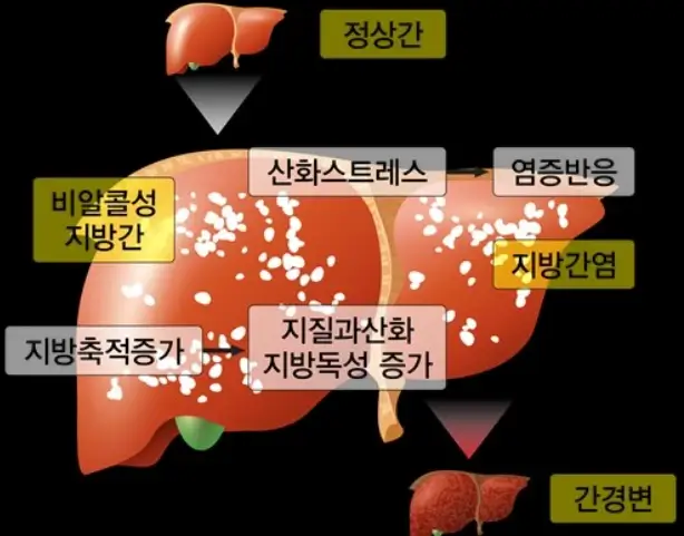 지방간