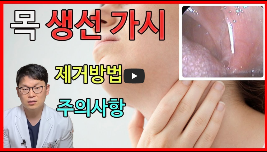 생선가시 제거법