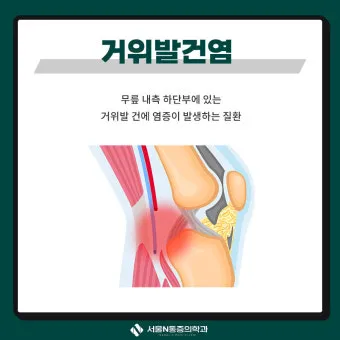 거위발 건염 원인과 증상 무릎 안쪽 통증 치료법 정리_8