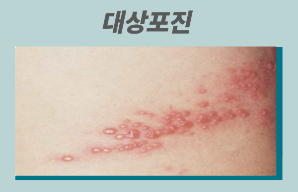 노인 대상포진