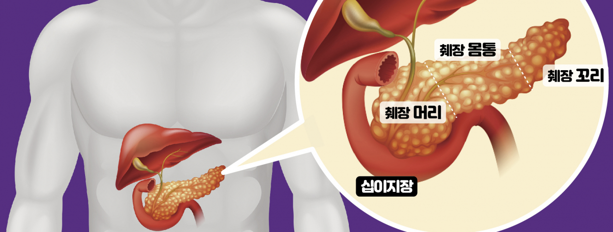 췌장염 2
