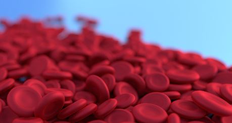 철결핍성 빈혈 vs 만성질환성 빈혈 관련 사진