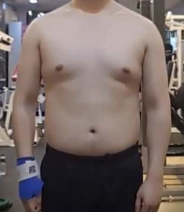 여유증