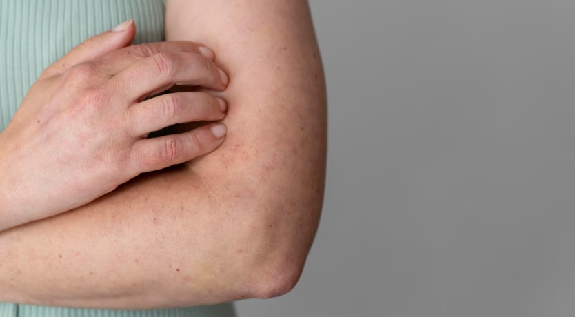 아토피 피부염의 요약