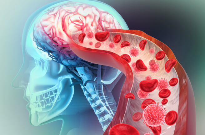 고혈압 뇌졸중 뇌혈관 예방법 고혈압관리 뇌혈관질환 혈압약 혈압측정방법 저염식 유산소운동 건강관리 혈관건강