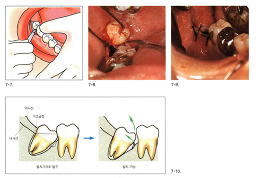 사랑니 발치 후 식사 가이드