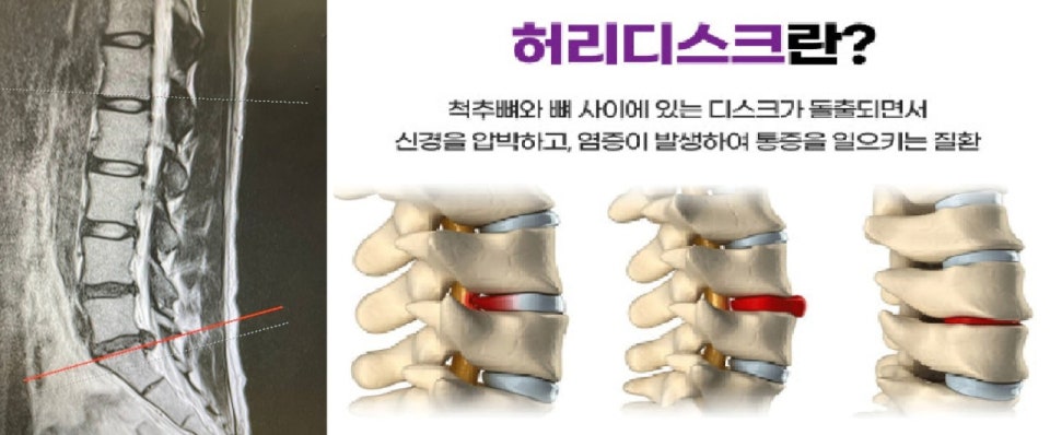 허리디스크관련사진