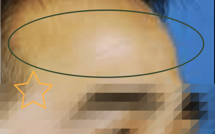 이마보톡스-효과로-이마에-주름이-없어진-남성의-모습