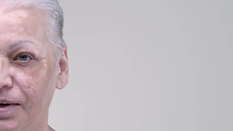 피부색이 달라지는 얼굴 백반증, 치료 가능할까?