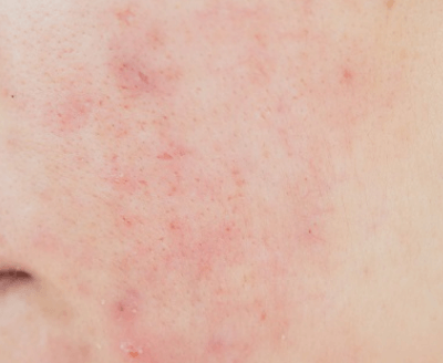 말라쎄지아(진균성 모낭염) 