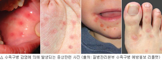 수족구병 증상 원인 치료 전염 수포 잠복기