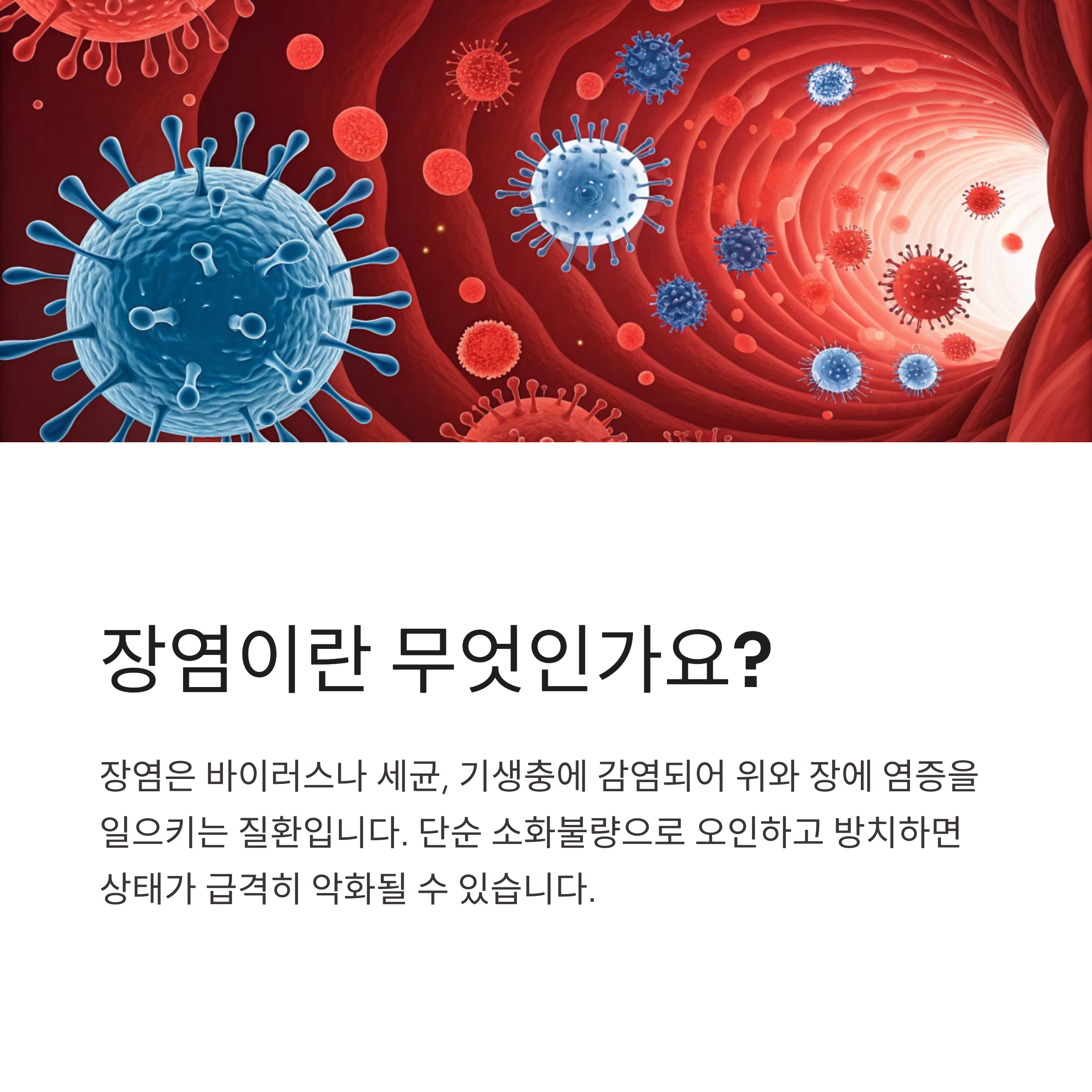 장염이란 무엇인가요?