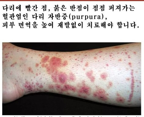 자반증
