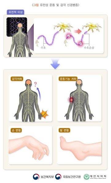 유전성 운동 및 감각 신경병증(HMSN, 샤르코-마리-투스병) 원인·증상·치료 총정리