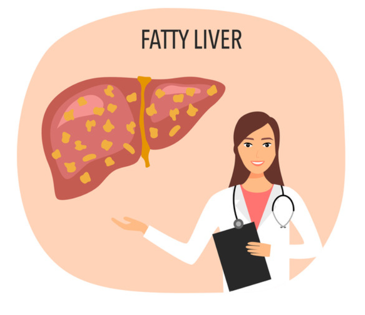지방간을 그림으로 표현