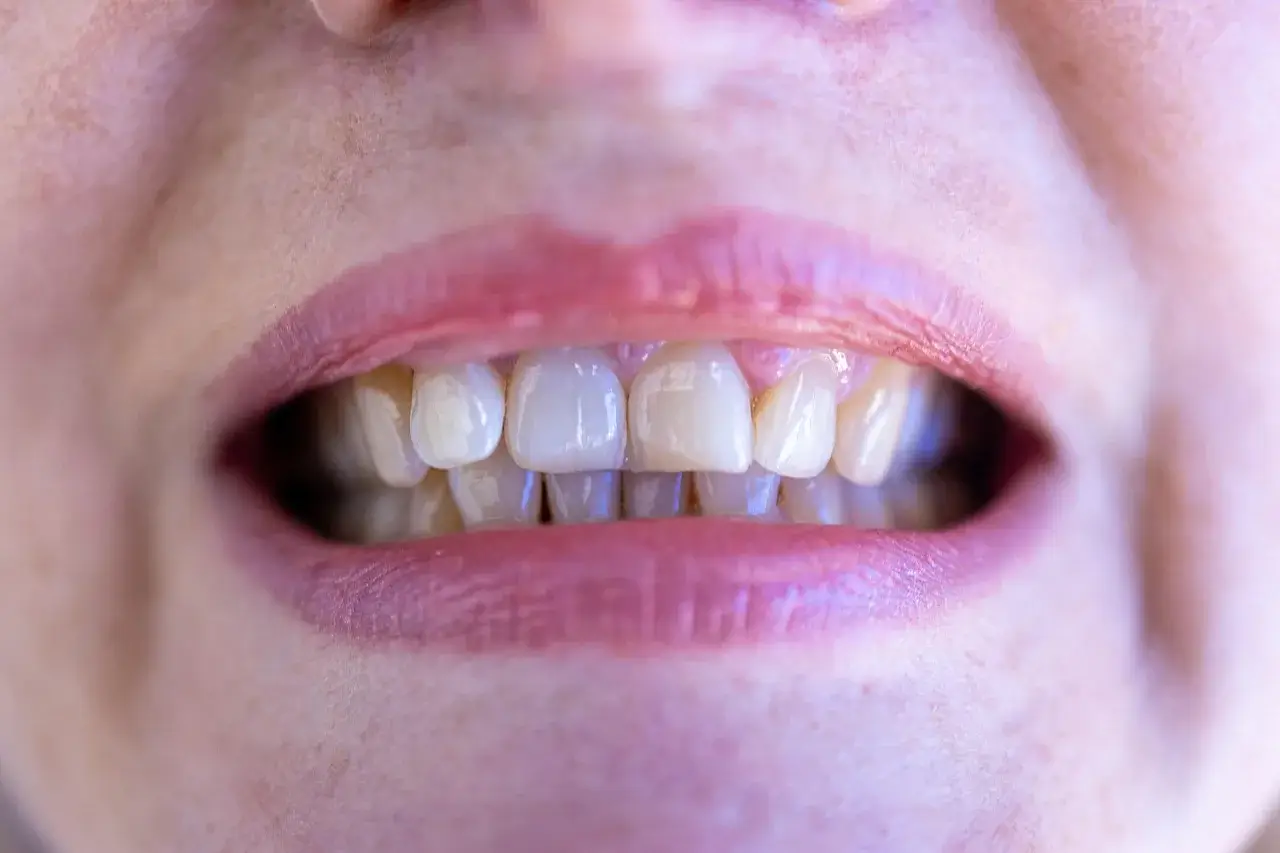 편도결석 제거법