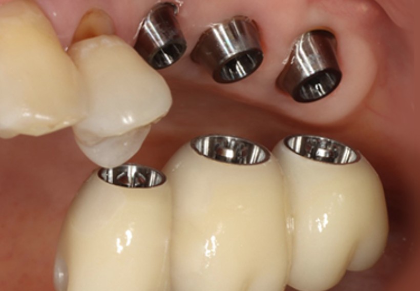 네오바이오텍 똑딱임플란트 구조&amp;#44; 체결방식