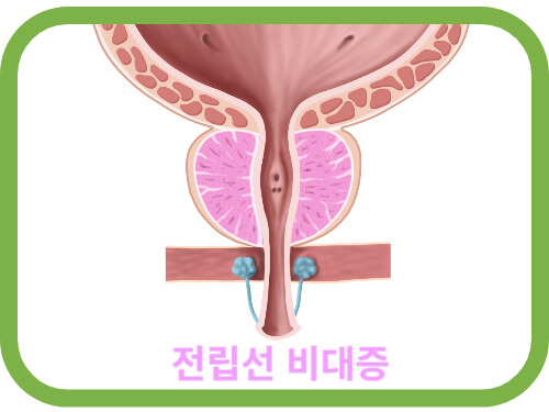 전립선-비대증