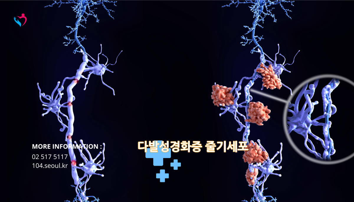 다발성경화증 줄기세포